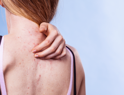 Los mejores tratamientos para el bacné: ¿Cómo deshacerse del molesto acné de la espalda?
