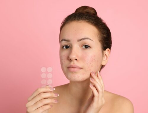 Tutto ciò che devi sapere sull’acne