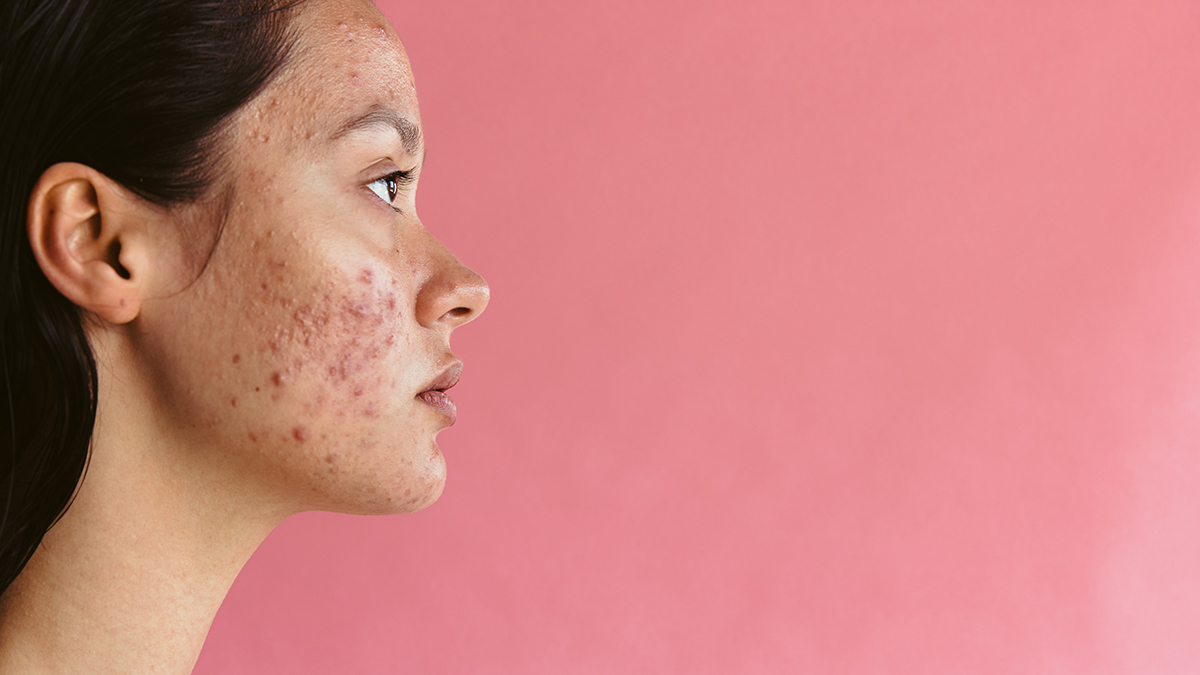 Side view portrait of a young woman with acne on pink background