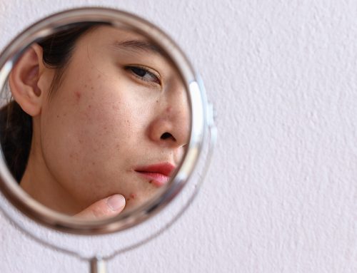 How to Love the Skin You’re in When You Feel Like an Unhappy Acne Kid