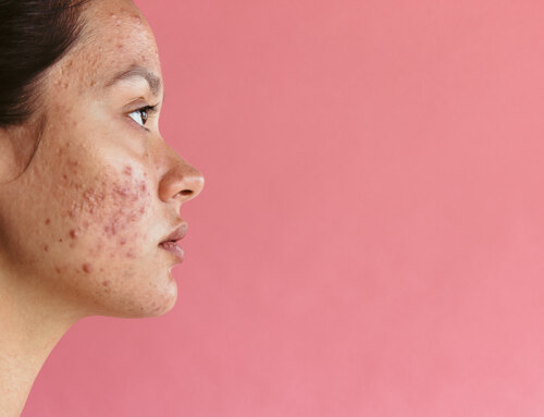 How to Get Rid of Acne?