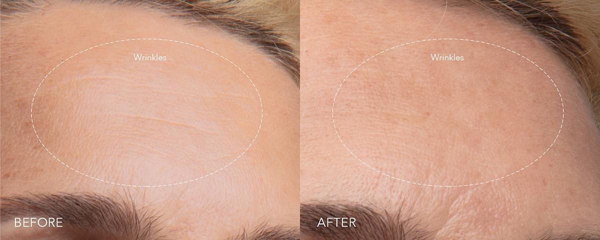 Closeup of a woman's forehead before and after using FOREO KIWI derma
