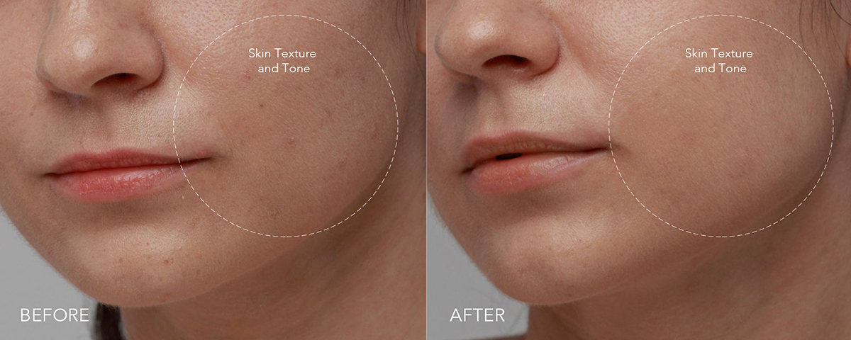 Closeup of a lower part of a woman's face before and after using FOREO KIWI derma